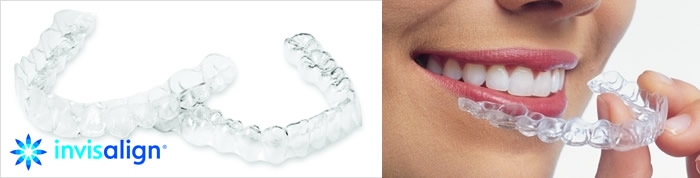 マウスピース矯正