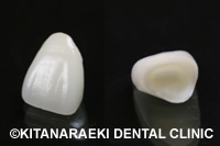 オールセラミック