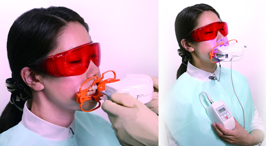 オフィスホワイトニング