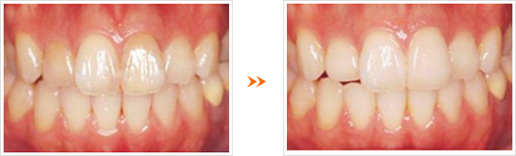 オールセラミッククラウンの症例