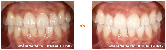 ホワイトニングのイメージ