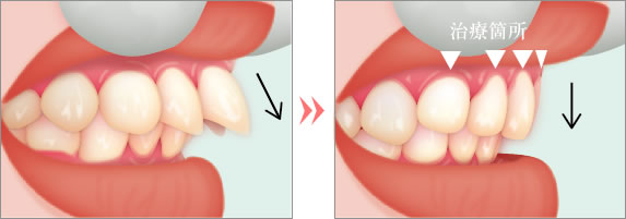 出っ歯の術前術後