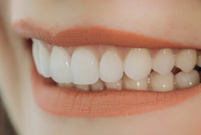 セラミック矯正