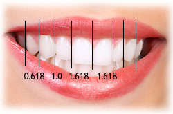 セラミック矯正
