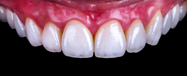 セラミック矯正治療箇所