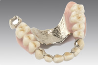 金属床義歯