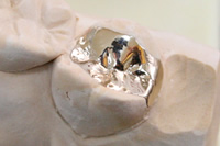 ゴールドインレー