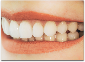 歯並びと同時に希望の白さや大きさ・デザインも選べる